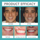 Adjustable Teeth Whitening -
