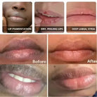 Remove Dark Lips Fast -